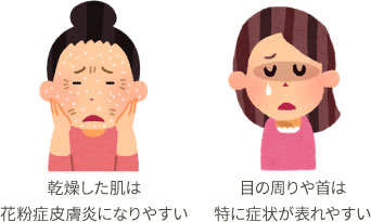 乾燥した肌は花粉症皮膚炎になりやすい 目の周りや首は特に症状が表れやすい