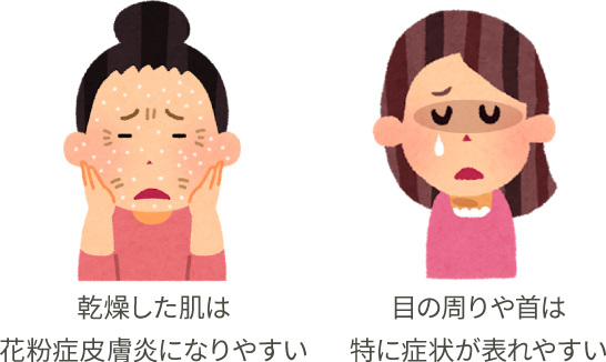 乾燥した肌は花粉症皮膚炎になりやすい 目の周りや首は特に症状が表れやすい